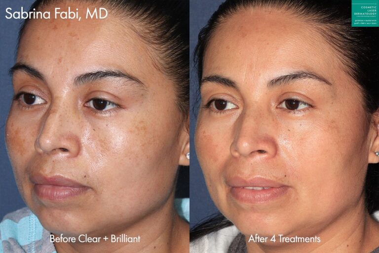 Clear + Brilliant laser to treat melasma by Dr. Fabi. After 4 treatments, brown patches are virtually undetectable.