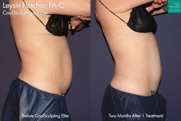 CoolSculpting Elite to trim and contour the abdomen by Leysin Fletcher, PA-C. After treatment, midsection is more slender and contoured.