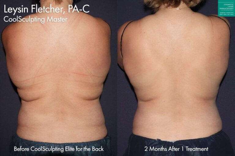 CoolSculpting Elite to treat back fat by Leysin Fletcher, PA-C. Two months after treatment, bra rolls are reduced and back is smoother.
