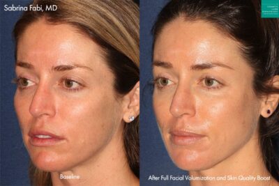 Dermal Fillers for full facial volumization and Botox for skin quality boost by Dr. Fabi. After treatment, patients facial contours and skin appearance are improved.