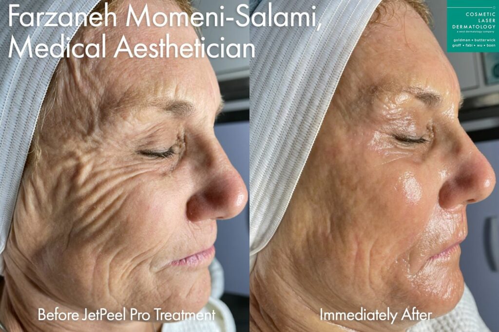 JetPeel facial results on San Diego patient