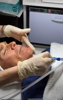 patient receiving a JetPeel treatment at Cosmetic Laser Dermatology in San Diego, CA