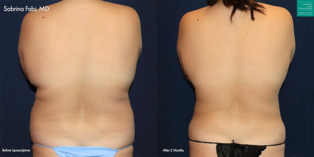 Liposuction Back and Flanks Treatment Gallery in New Bern, NC