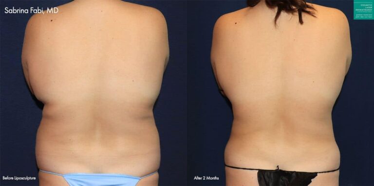 Liposculpture to trim the back, abdomen, and flanks of a female patient by Dr. Fabi. After procedure, midsection is more slender and sculpted.