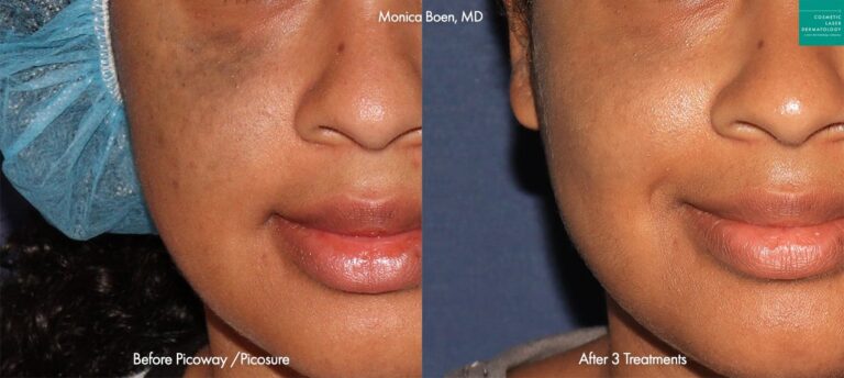 PicoWay and PicoPlus lasers to treat Nevus of Ota on the face of a female patient by Dr. Boen. After 3 treatments, skin is visibly clearer.