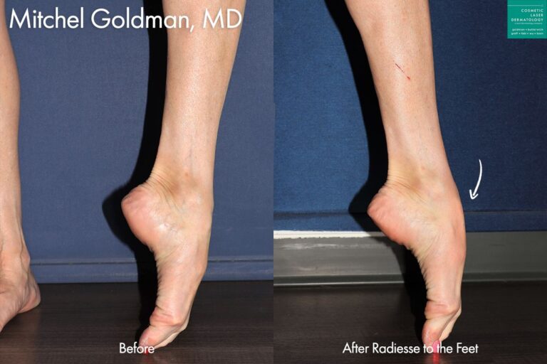 Radiesse to improve the appearance of the feet and ankles by Dr. Goldman. After treatment, veins are less prominent and skin is smoother.