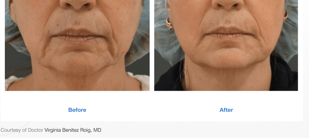before and after sofwave