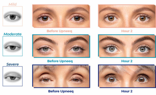 graphic illustrating the before and after results from Upneeq eye drops now available at CLDerm in San Diego