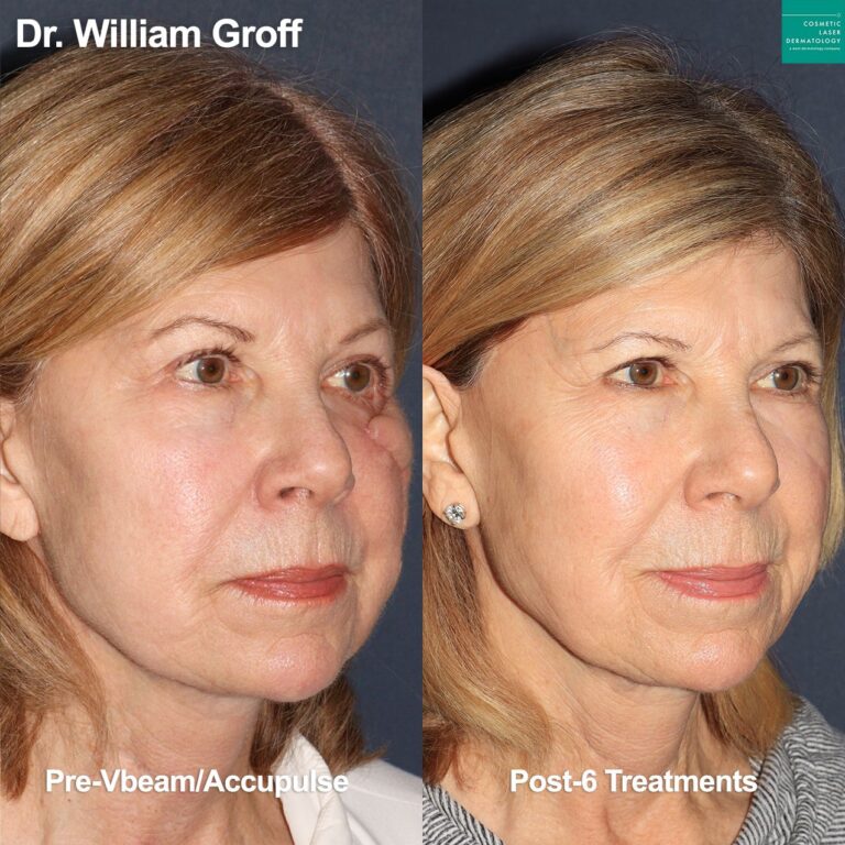 Vbeam and Acupulse used to treat scar on face of female patient by Dr. Groff. After treatment, scar is virtually undetectable.