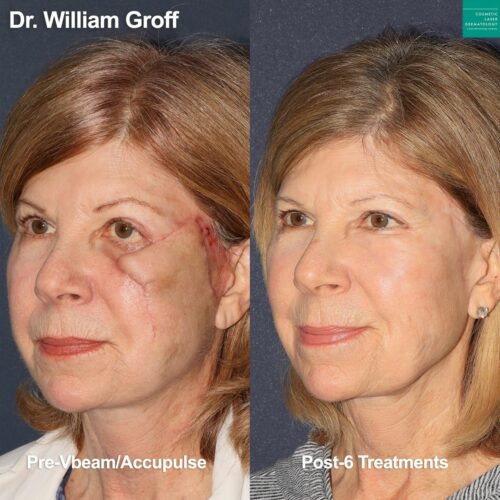 clderm Vbeam and Acupulse used to treat scar on face of female patient by Dr. Groff. After treatment, scar is virtually undetectable san diego ca