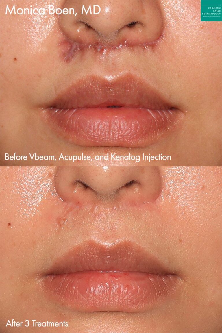 Vbeam, Acupulse, and Kenalog Injection to treat the scar of a female patient by Dr. Boen. After treatment, scar is barely visible.