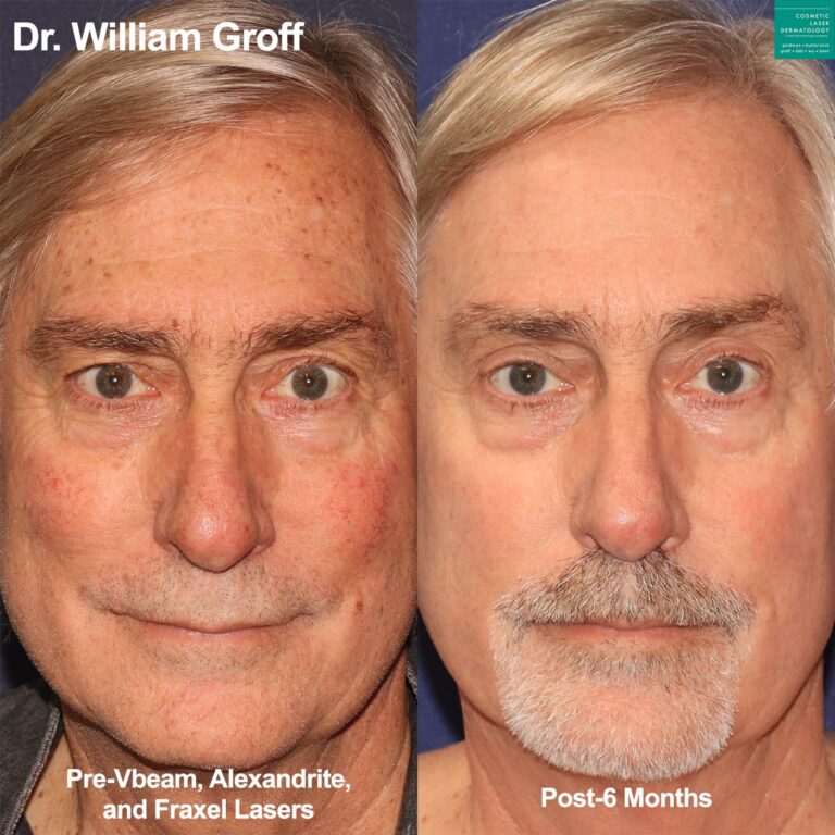 Vbeam, Alexandrite, and Fraxel lasers to treat sun damage on a male patient by Dr. Groff. After treatment, brown spots are gone, lines are reduced, and skin looks smoother and more youthful.