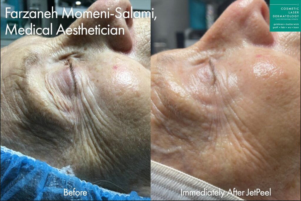 JetPeel facial results in San Diego, CA