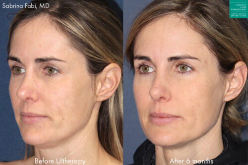 Skin Tightening - Aguirre Specialty Care