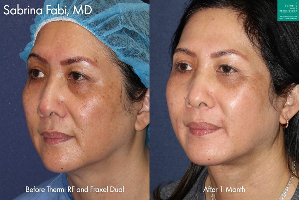 before and after results from a Fraxel treatment in San Diego, CA