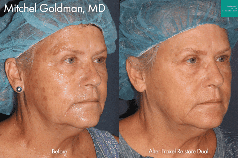 Fraxel Restore Dual to Rejuvenate the Skin of a Female Patient by Dr. Goldman. After laser treatment, patient's skin is smoother and sun damage is less visible.