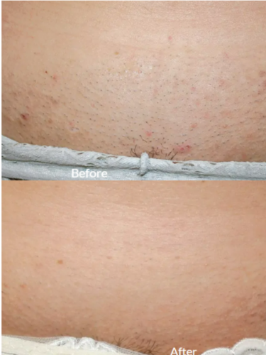 cosmetic laser dermatology splendor x procedure before and after san diego ca