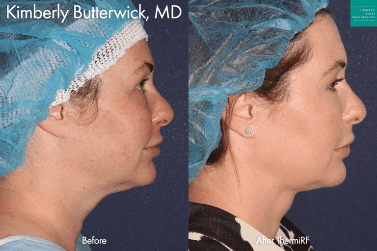 ThermiRF to tighten skin under chin and on neck by Dr. Butterwick. After treatment, jawline is more defined and neck is more contoured and youthful.