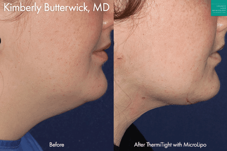 ThermiTight with MicroLipo to contour the chin, jawline, and neck by Dr. Butterwick. After treatment, the jawline is more contoured and submental fat is significantly reduced.