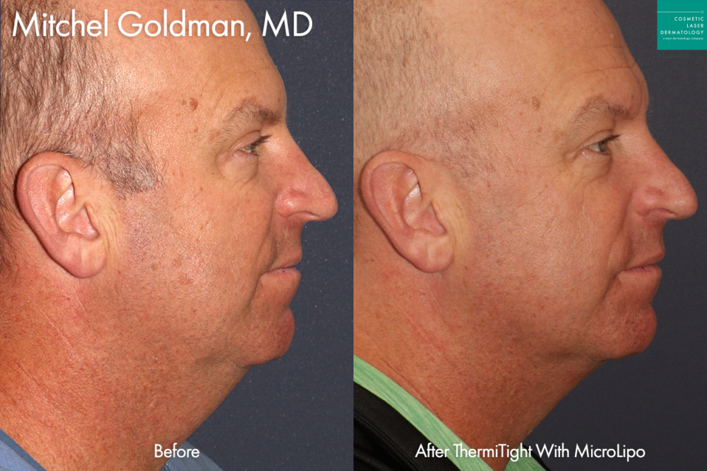 ThermiTight and MicroLipo to sculpt the chin, jawline, and neck of a male patient by Dr. Goldman. Disclaimer: Results may vary from patient to patient. Results are not guaranteed.