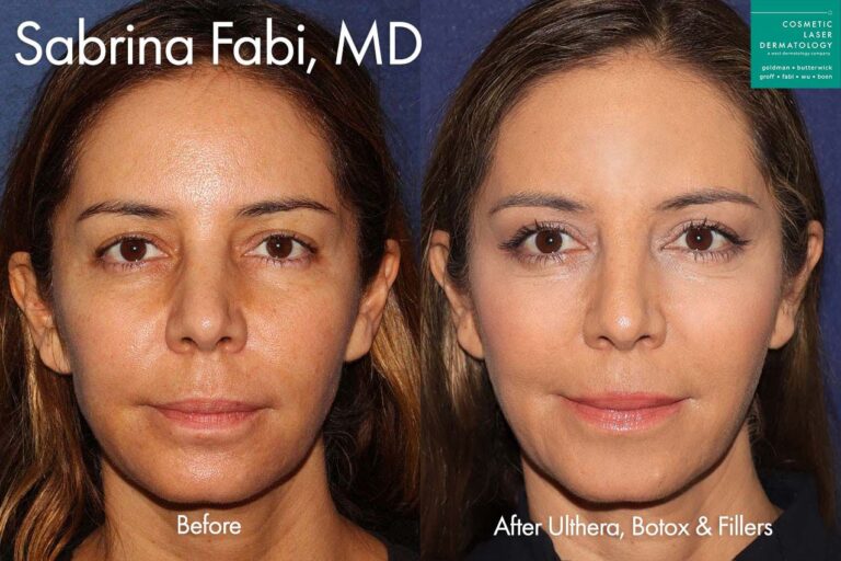 Ultherapy, Botox, and Fillers to refresh the appearance of a female patient by Dr. Fabi. After treatment, skin is firmer and smoother, and patient's face has a more youthful contour.