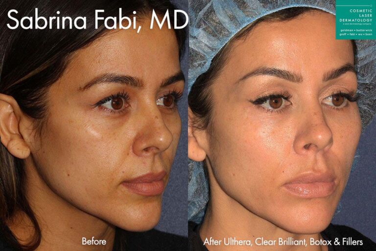 Ultherapy, Clear+Brilliant, Botox, and Fillers to refresh the appearance of a female patient by Dr. Fabi. After treatment, skin is firmer and smoother, and patient's face has a more youthful contour.