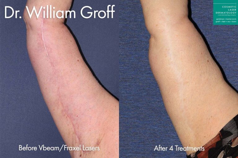 Vbeam and Fraxel lasers used to treat brachioplasty scar under the arm by Dr. Groff. After 4 treatments, scar is barely detectable.