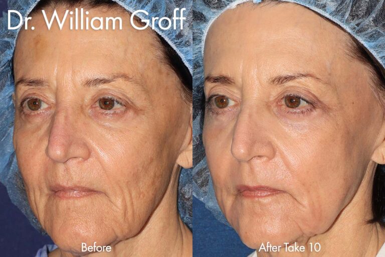 Take 10 treatment using lasers to rejuvenate the appearance by Dr. Groff. After procedure, patient's skin is smoother and more youthful, with fewer lines and wrinkles.