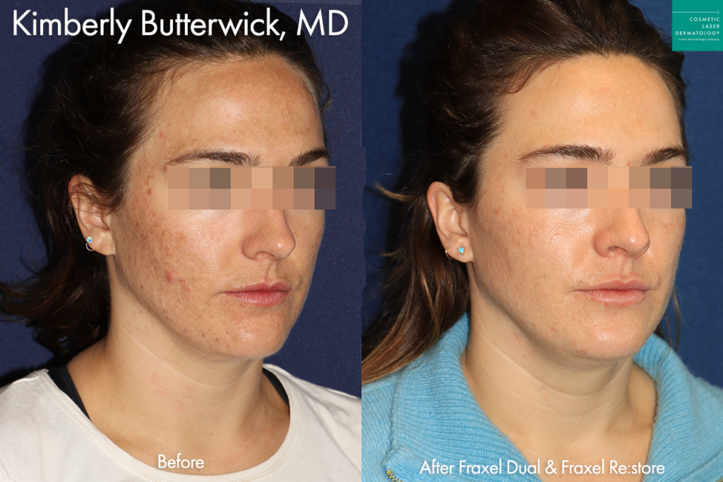 clderm Fraxel Dual and Fraxel Re:store to reduce acne scarring and hyperpigmentation by Dr. Butterwick. After treatment, skin is clearer and smoother. san diego ca