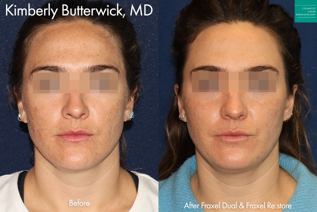 Fraxel Dual and Fraxel Re:store to reduce acne scarring and hyperpigmentation by Dr. Butterwick. After treatment, skin is clearer and smoother. san diego ca