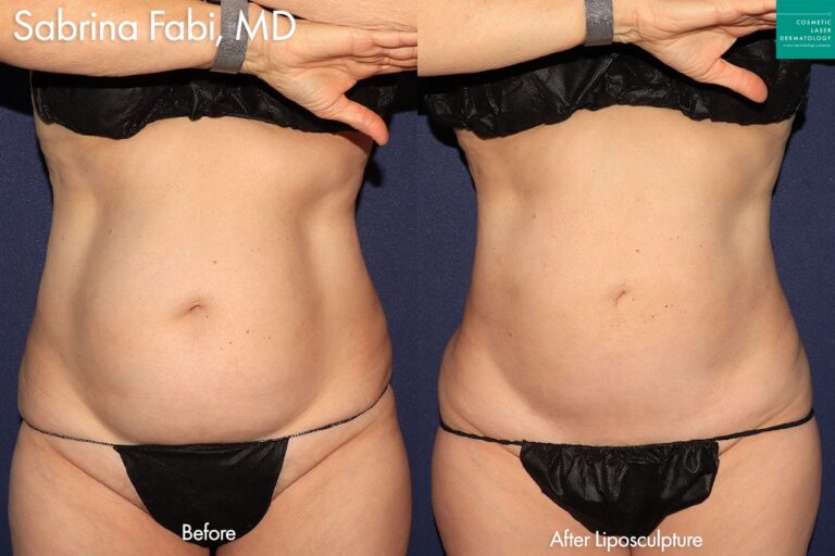 Liposculpture to trim abdomen and flanks by Dr. Fabi. After procedure, the abdomen and flanks are more slender & sculpted.