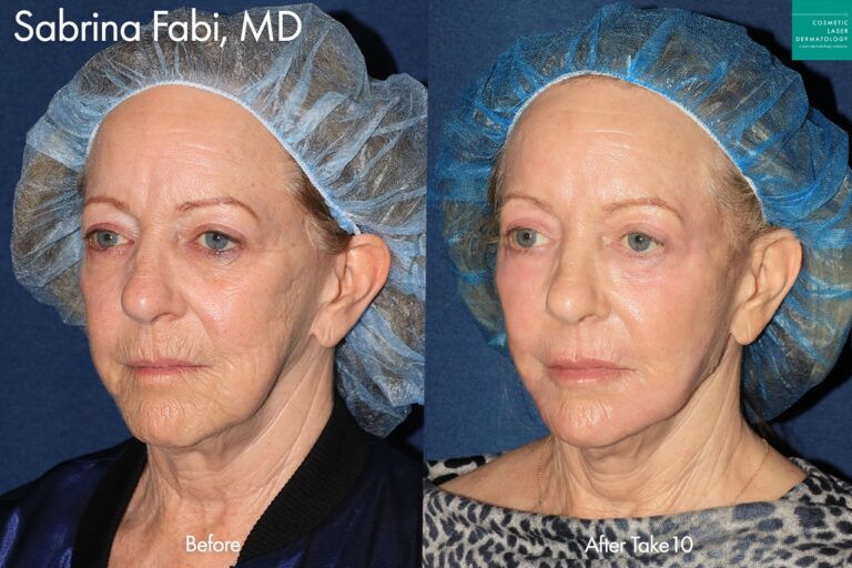 Take 10 treatment for a rejuvenated appearance by Dr. Fabi. After, patient's wrinkles are less defined, her skin tone is much more even, and she looks more youthful overall.