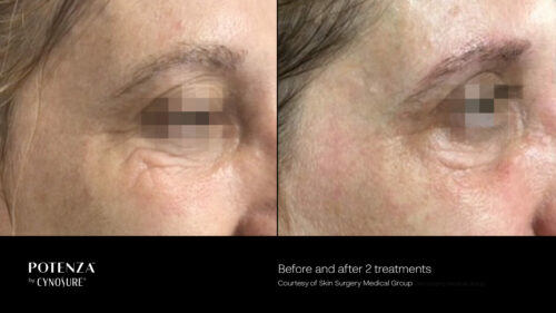 cosmetic laser dermatology potenza microneedling before and after in san diego ca