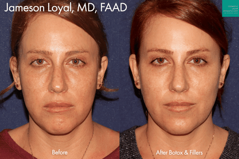 Botox and fillers to refresh appearance and shape face by Dr. Loyal. After treatment, patient's face is much more balanced and her wrinkles are softened.