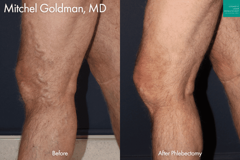 Phlebectomy to reduce varicose veins by Dr. Goldman. After treatment, this patient's varicose veins are gone.