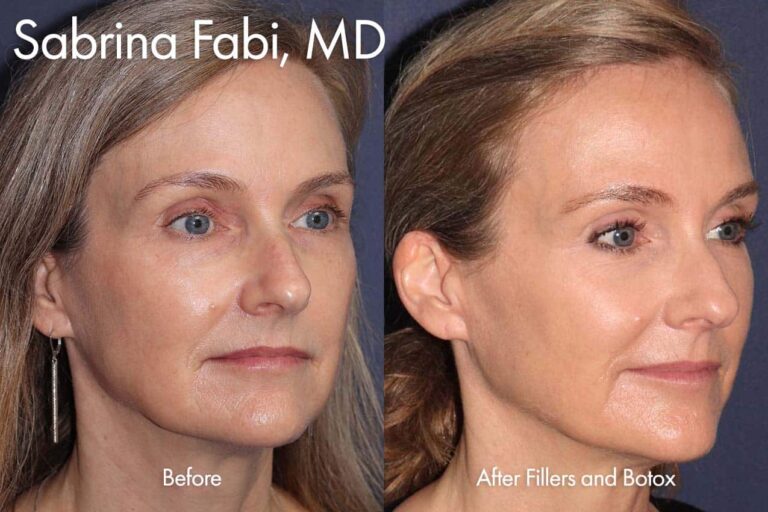 Fillers and botox to reduce wrinkles by Dr. Fabi. After treatment, wrinkles are reduced and face is more contoured.