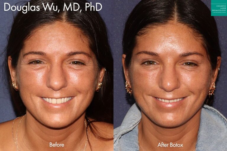 Botox to reduce crow's feet by Dr. Wu. After treatment, fine lines in outer corners of eyes are greatly reduced.