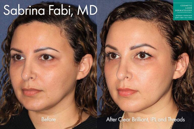 Clear + Brilliant, IPL, and Silhouette Instalift to refresh face by Dr. Fabi. After treatment, patient's face look much more balanced and uplifted.