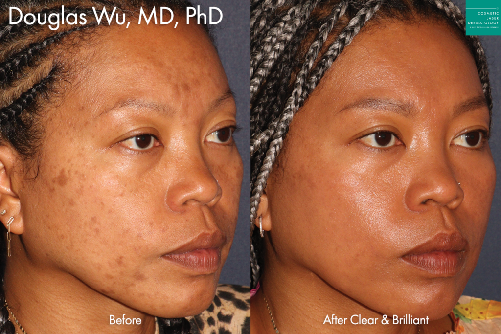 clderm clear & brilliant before and after san diego ca