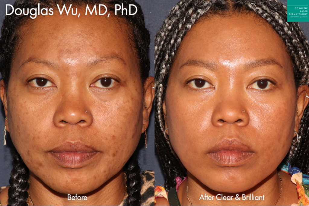 cosmetic laser dermatology clear & brilliant treatment before and after san diego ca