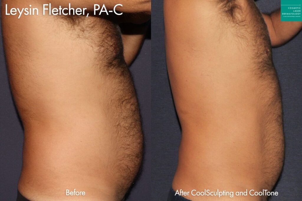 CoolSculpting Elite and CoolTone to sculpt the abdomen by Leysin Fletcher, PA-C. After treatment abdomen is flatter and more contoured.