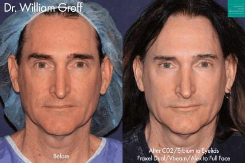 C02, Erbium, Fraxel Dual, Vbeam, and Alexandrite lasers to rejuvenate appearance of male cosmetic patient in San Diego. After treatment, patient's skin texture is rejuvenated and any brown spots are gone.