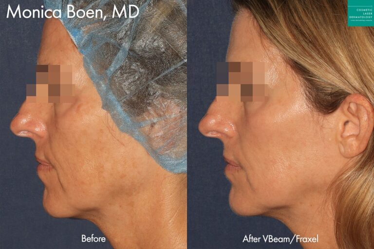 Vbeam and Fraxel Dual to treat sun damage by Dr. Boen. After treatment skin is smoother and discoloration is significantly reduced.