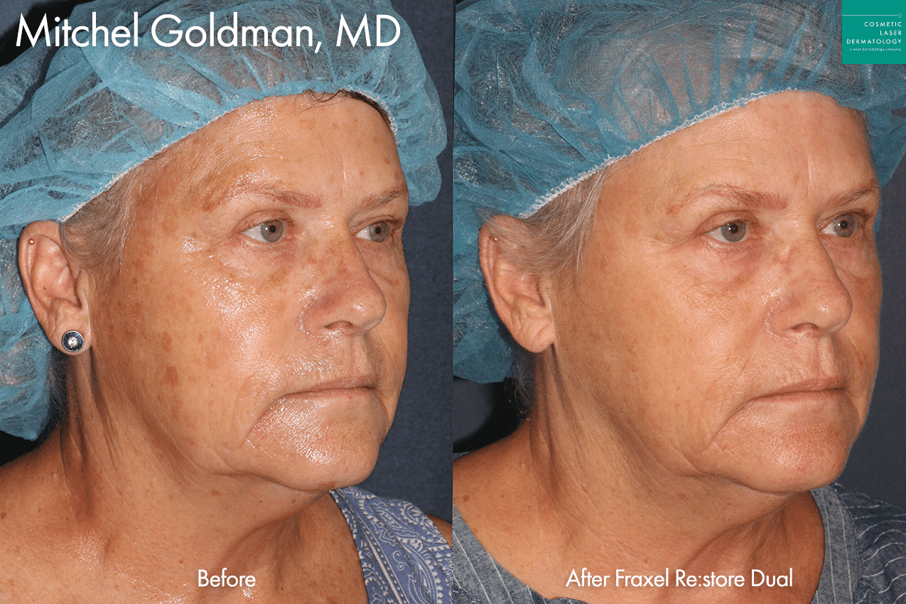 Oblique angle of female patient showcasing results from fraxel laser resurfacing in San Diego