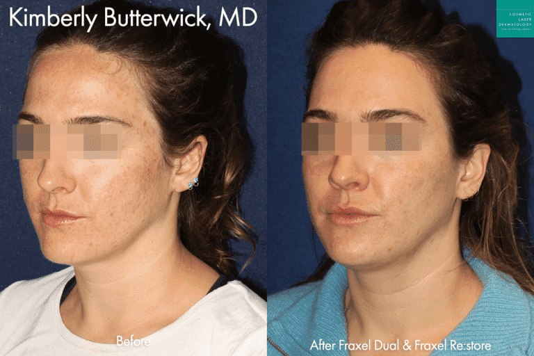 Fraxel Dual and Fraxel Re:store to reduce acne scarring and hyperpigmentation by Dr. Butterwick. After treatment, skin is clearer and smoother.