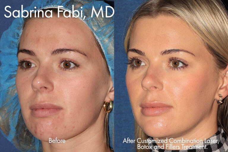 Customized laser combination, botox, and fillers to refresh appearance by Dr. Fabi. After 5 years, this patient's skin looks clearer than before and just as youthful.
