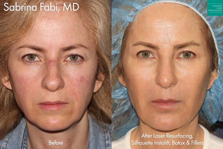 Laser resurfacing, Silhouette Instalift, Botox, and Fillers for anti-aging by Dr. Fabi. After ten years, she looks frozen in time. Her face is more balanced, her wrinkles are softened, and her skin quality is improved.