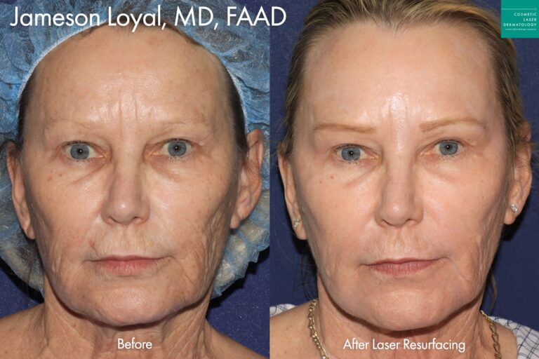 Laser resurfacing for skin rejuvenation by Dr. Loyal. After treatment, her brown spots are reduced, her skin is less crepey, and her overall skin quality is improved.