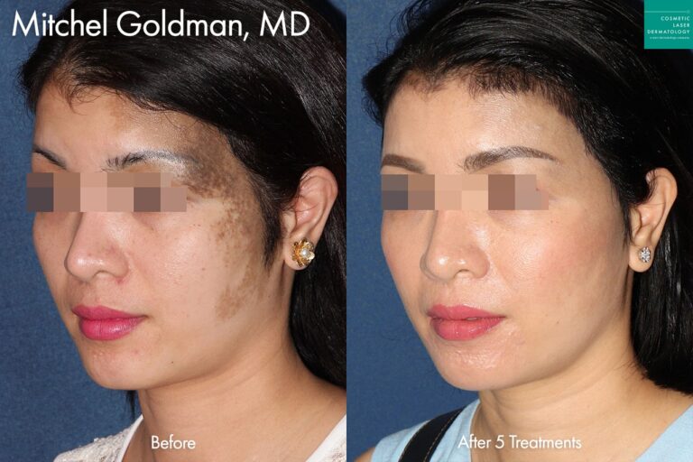PicoSure to treat Nevus of Ota by Dr. Goldman. After 5 treatments, her skin is visibly clearer.