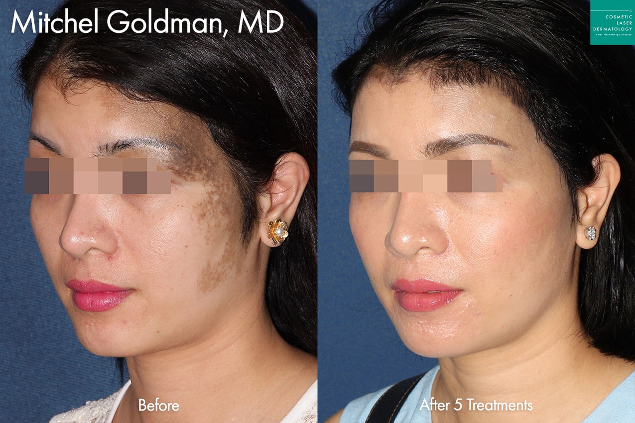 Before And After Photos San Diego CA Cosmetic Dermatology